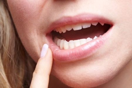 5 dicas infalíveis para curar Aftas - Dica de Saúde